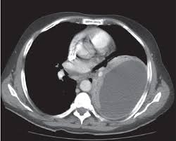 Loculated effusion (shown in the images below) is characterized by an absence of a shift with a change in this case of loculated pleural effusion (e), the configuration of the fluid suggests a free. View Image