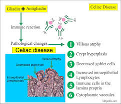 Almost everyone with celiac has them in their. Gliadin Antibodies Iga Igg Endomysial Antibodies Celiac Disease And Celiac Sprue Labpedia Net