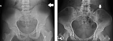 Image result for Risser Sign