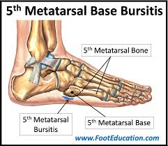 Image result for Metatarsal