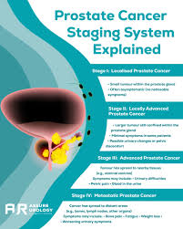 Image result for Prostate Cancer Staging