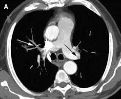 Image result for CT Intravenous Contrast