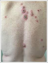Image result for skin rash acute hiv infection