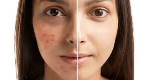 How to Remove Dark Spots Caused by Pimples Naturally?