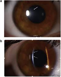 Fine-Tune Your Corneal Disease Diagnostic Skills