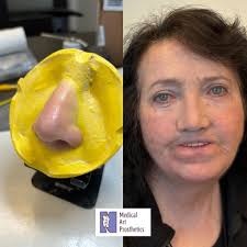 Another nasal prosthesis and another happy patient! Nasal prostheses can be  life changing when it comes to quality of life and feeling like oneself  again. #nasalprosthesis #prostheticnose #facialprosthetics #anaplastology  #maxillofacialprosthetics