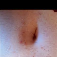 Like many trends before it, the navel hysteria eventually faded, and the belly button became nothing more than the place your umbilical cord used to be once again. How To Get Rid Of Red And Brown Ingrown Hair Scars Underneath Belly Button Due To Shaving And Picking Photos