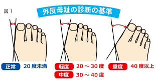 好きな靴が履けない「外反母趾」 ９割以上が女性｜岡山の医療健康ガイド MEDICA