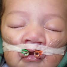 NAM Appliances for Cleft Palate