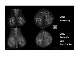 What does an abnormal mammogram look like? Ai Can Already Detect Breast Cancer Better Than A Specialist Innovation Origins