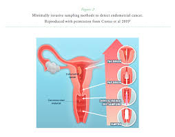 Almost all cervical cancers are caused by persistent infections with specific types of human papillomavirus (hpv). The Pap Test Beyond Cervical Cancer Screening
