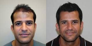 Full And Thick Density 1 Procedure Hair Transplant Result Dr Brett Bolton Continues To Get The Best One Proce Hair Transplant Hair Transplant Results Bolton