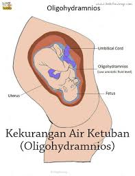 Tak mengherankan jika ibu tidak bisa membedakan apakah cairan yang merembes adalah air ketuban atau urine. Tanda Air Ketuban Bocor