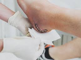 When left untreated, chronic wounds can diminish your quality of life and prevent you from doing the activities you enjoy. Types Of Wound Healing Primary Secondary Tertiary And Stages