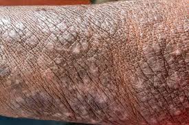 Image result for skin rash acute hiv infection