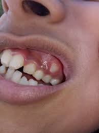 Overbite is one of the most common dental problems. Malocclusion Wikipedia