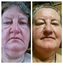 Have you noticed changes in wrinkles after starting a new diet?