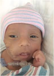 Lifesaving Ex Utero Intrapartum Treatment in a rapidly growing facial mass  identified during labor