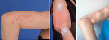 The cost of surgical tattoo removal tends to be lower than laser removal and dermabrasion. Dealing With Tattoos In Plastic Surgery Tattoo Removal Sciencedirect