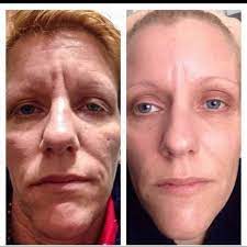 More consumers are beginning to ignore the negative say and opening with that in mind, cbd oil is now touted as a safer and more effective alternative treatment for a wide range of common ailments, including diabetes. Jeunesse Instantly Ageless Reviews Before After Pictures Jeunesse Luminesce And Instant Jeunesse Instantly Ageless Instantly Ageless Anti Aging Skin Routine
