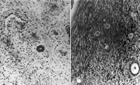 Image result for True Hermaphroditism