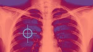 Earliest warning signs and symptoms oflung cancer. How My Lung Cancer Diagnosis Taught Me To Advocate For Myself Everyday Health