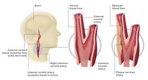 If one of them is narrowed or blocked, it can lead to a stroke. Carotid Disease Treatment Dr Ahmed Farah Abdulrahman