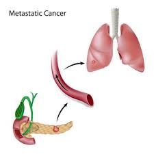 On l'appellera dans ce cas cancer des îlots pancréatiques*. Tout Sur Le Cancer Du Pancreas