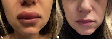 Doctors are seeing patients experience pain, swelling and inflammation for. Oral Angiotensin Converting Enzyme Inhibitors For Treatment Of Delayed Inflammatory Reaction To Dermal Hyaluronic Acid Fillers Following Covid 19 Vaccination A Model For Inhibition Of Angiotensin Ii Induced Cutaneous Inflammation Jaad Case Reports