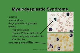 Myelodysplastic Syndrome Google Search Visual Learners Syndrome Internal Medicine