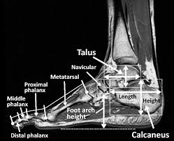 Image result for Calcaneus