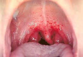 Image result for Physical injury red spots roof of mouth