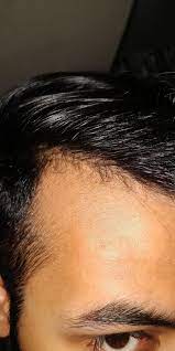 Hey Guys Im 20 With A Receded Hairline And Recently I Saw These Tiny Hair On My Bald Spot Zoom To See Will They Grow Or Hair Hairline Celebrity Hair Colors