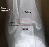 Image result for icd-10 code for displaced distal fibula fracture