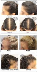 No matter how luscious your locks have seemingly always been, at one point or another, that volume will lessen (for some more than others). Female Hair Loss Treatments