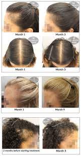 This drug was initially introduced as a treatment for high blood pressure, but people who took it noticed that they were growing hair in places where they had lost it. Female Hair Loss Treatments