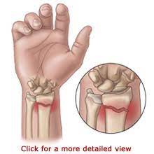 Maybe you would like to learn more about one of these? How Long Does It Take To Recover From A Fractured Wrist