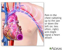 Chest Pain Information Mount Sinai New York