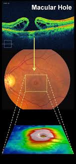 Macular Hole Los Angeles Vitrectomy Surgery Eye Health Eyes Problems