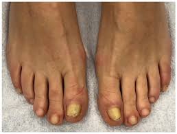 Image result for onychomycosis
