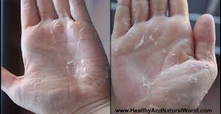Your feet may peel due to lifestyle habits or certain exposures. Why You Should Never Ignore Peeling Skin On Hands Or Fingers Peeling Fingertips Peeling Skin Skin Peeling On Fingers