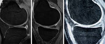 In dieser zeit heilt die quetschung in der regel folgenlos aus. Internationales Zentrum Fur Orthopadie Kniechirurgie Arthroskopie Meniskus