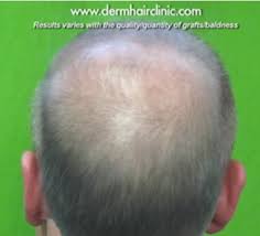 The new transplanted hair is not affected any dr. Hair Loss Info Dermhair Clinic Los Angeles 1 310 318 1500