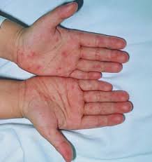 The virus then multiplies at the site of intrusion, mainly in the nasopharynx and the lymph node regions. Vesicular Or Bullous Cutaneous Lesions Flashcards Cram Com