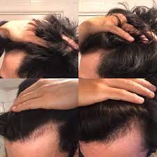 Jul 05, 2021 · shedding microneedling minoxidil bart experiment mit minoxidil fur mehr bartwuchs bartmentor microneedling is a minimally invasive cosmetic treatment that involves puncturing the skin using fine needles or dermaroller to boost from cdn.shopify.com and my perception generally is that the process of microneedling at the. Finasteride Nizoral And Dermarolling 2 Months Update Tressless