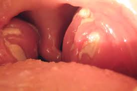 Image result for Canker sores roof of mouth