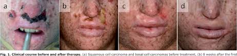 Overview of their presentation, pathogenesis, associations, and treatment. Pdf Electrochemotherapy For Non Melanoma Skin Cancer In A Child With Xeroderma Pigmentosum Semantic Scholar