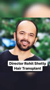 Rohit Shetty Hair Transplantation , 👉For Hair Transplant Massage