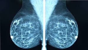 Breast cancer is the most common cancer in the uk, and one in eight women will develop it at some point in their lives. Japanese Team Develops Promising Breast Cancer Detection Method The Japan Times