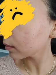 Acne] Läkaren och mamma PRESSAR på mig att ta Accutane, vi bråkade precis  på mötet. Jag är 19, har haft acne i ungefär 5 år, och är på väg att ge  efter